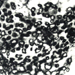 Cancer Cells Part 1
